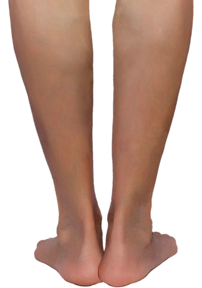 Lower legs at the earliest stage of venous disease — the skin is still clear, with no prominent surface veins