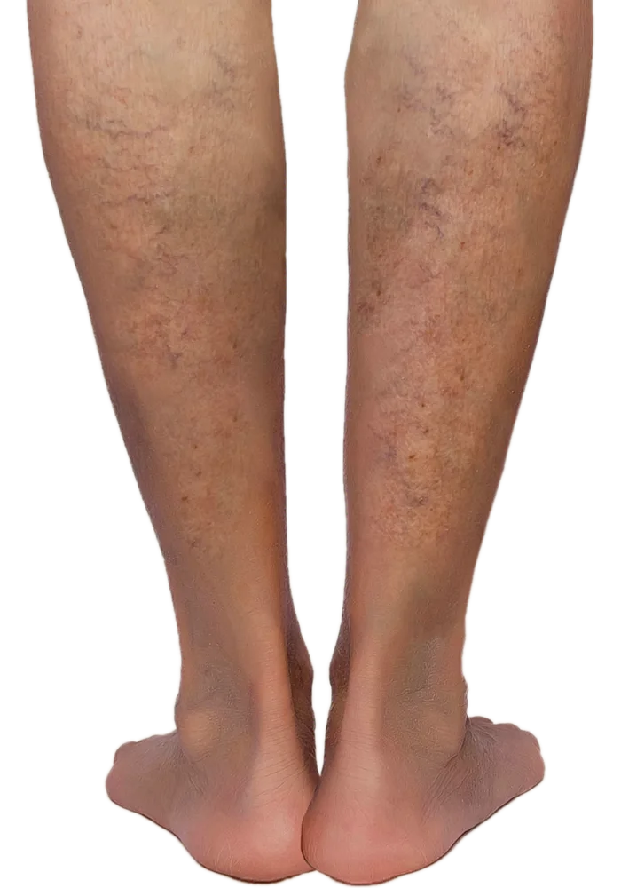 Fine, web-like spider veins visible across the back of both lower legs
