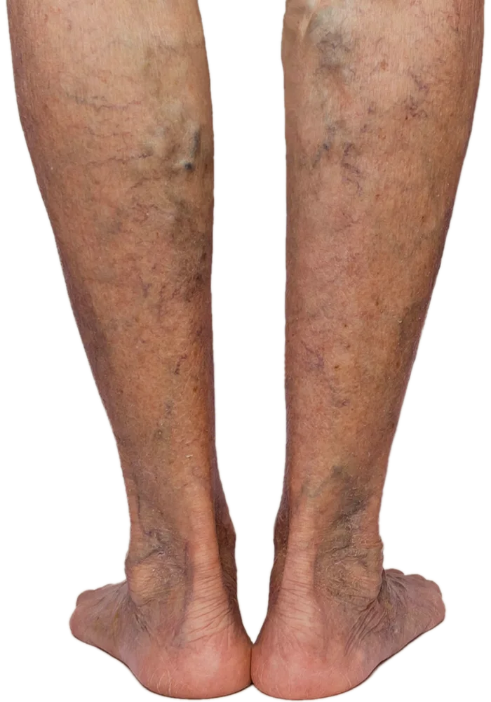 Clustered reticular veins spreading across both lower legs and ankles as venous pressure builds