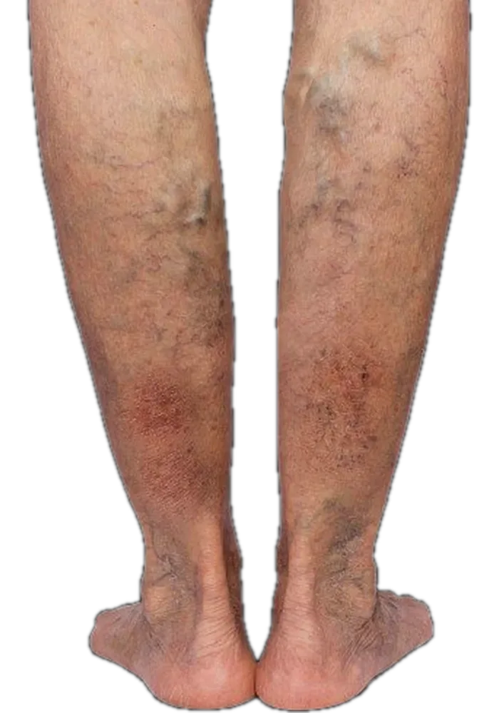 Reddish-brown discoloration developing over the lower legs and ankles, with dense surface veins beneath
