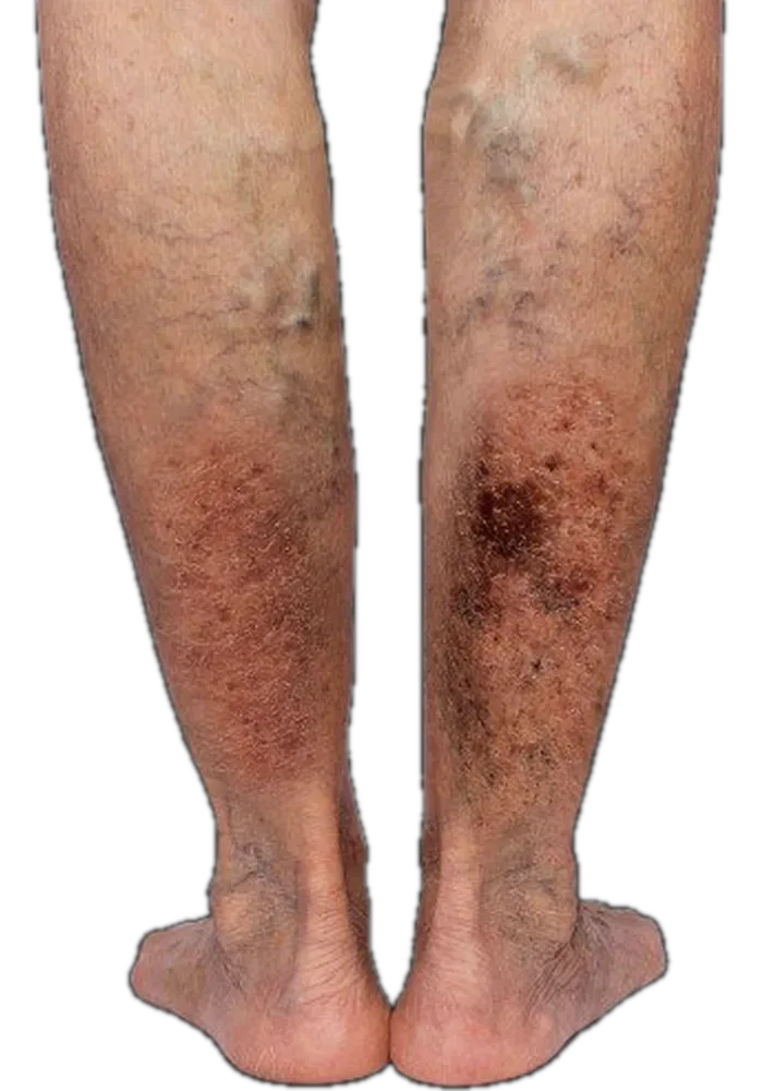 Advanced venous skin change — dark hyperpigmentation and thickened skin across the lower legs and ankles